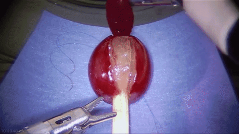 Brain Surgery, The Robot Efficacy Test?